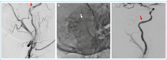 Endovascular Treatment in Symptomatic Intracranial Artery Stenosis: Experience from Two Centers.