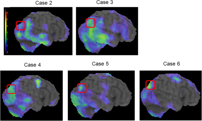 Case series of patients with early psychosis presenting hypoperfusion in angular gyrus and self-disturbance: Implication for the sense of agency and schizophrenia.