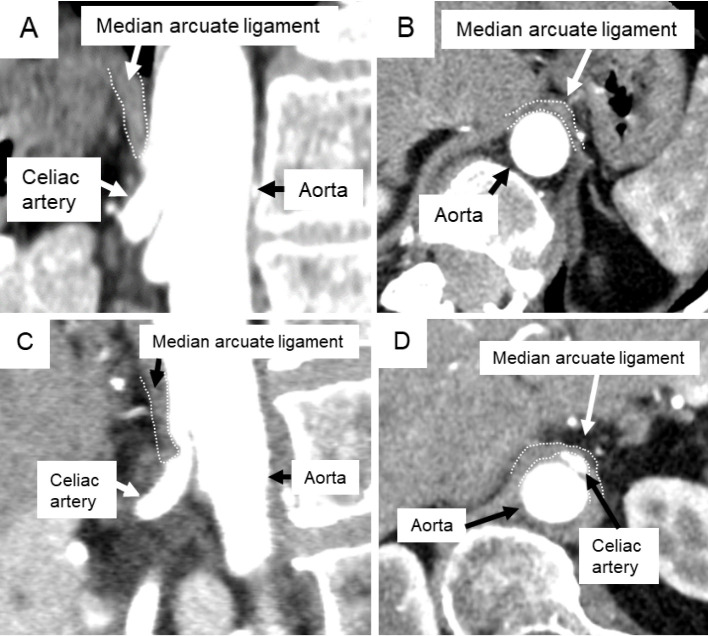 Quantitative Assessment of Celiac and Superior Mesenteric Artery Diameters in Adult Spinal Deformity Surgery Using Three-dimensional Computed Tomography.