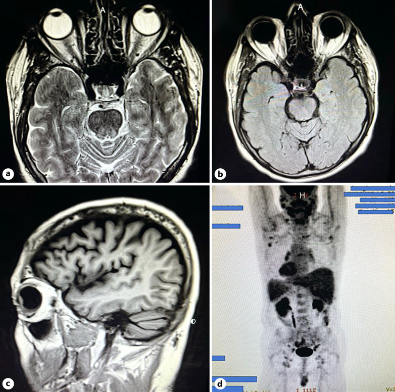 Candy Cane Hypopyon Secondary to Intraocular Mantle Cell Lymphoma: A Case Report.