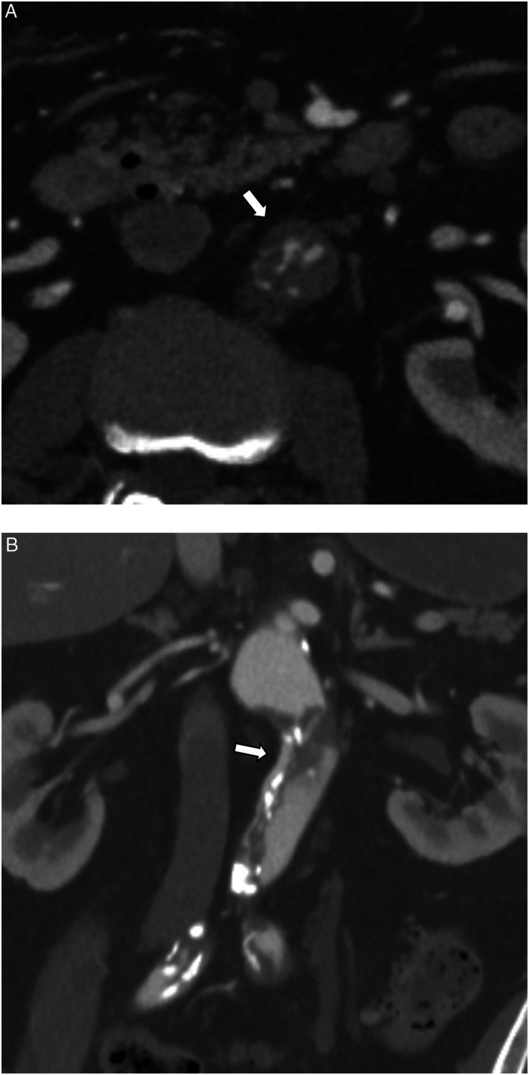 Endovascular stent graft treatment for stenosis in isolated infrarenal abdominal aortic dissection: A case report.