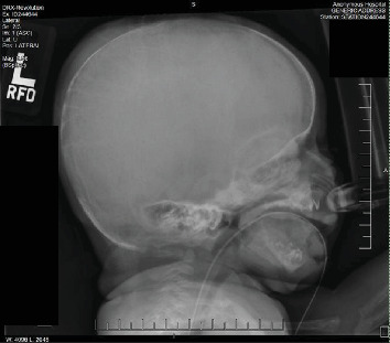 Demineralization of Osseous Structures as Presentation of a Rare Genetic Disorder That Is Associated With a High Rate of Mortality.