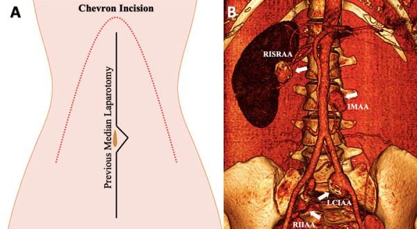 Repair of multiple abdominopelvic aneurysms: is the open approach still valid? A case report.