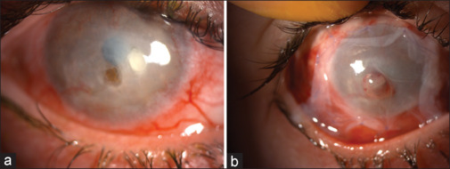 Sandwich Technique and Amniotic Membrane Transplantation as an Effective Method in Repairing Corneal Perforations.