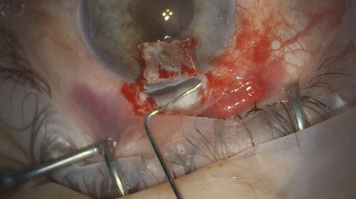 Ab externo Schlemm's canal surgery: Efficacy and safety outcomes.