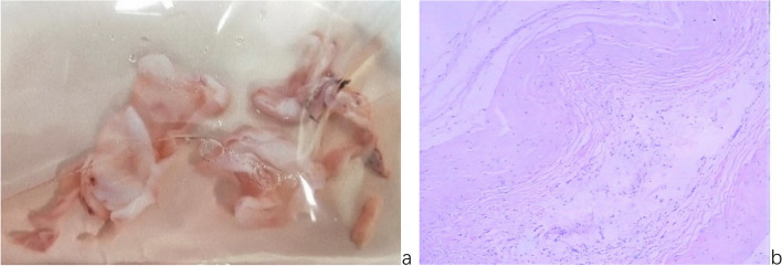 Nonadjustable state of programmable shunt valve: obstruction of middle cranial fossa arachnoid cyst-peritoneal shunt.