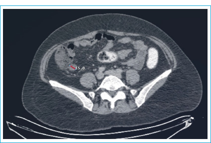 Surgical Management of Acute Appendicitis in a Patient with Diagnosed but "Unprepared" Pheochromocytoma: A Case Report.