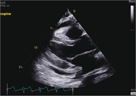 Cardiac Tamponade Secondary to Esophagopericardial Fistula.
