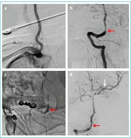 Endovascular Treatment in Symptomatic Intracranial Artery Stenosis: Experience from Two Centers.