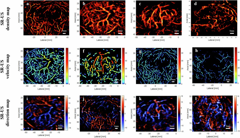 Focal liver lesions: multiparametric microvasculature characterization via super-resolution ultrasound imaging.