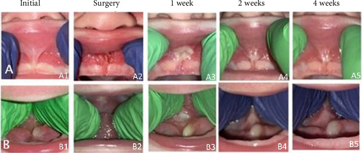 Breastfeeding Symptom Resolution After Sequential Labial-Lingual Frenectomies: A Case Report.