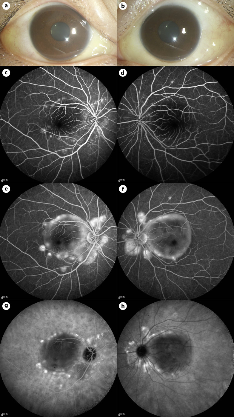 Bilateral Serous Retinal Detachment as an Initial Manifestation of Systemic Lupus Erythematosus due to Hypoalbuminemia: A Case Report.