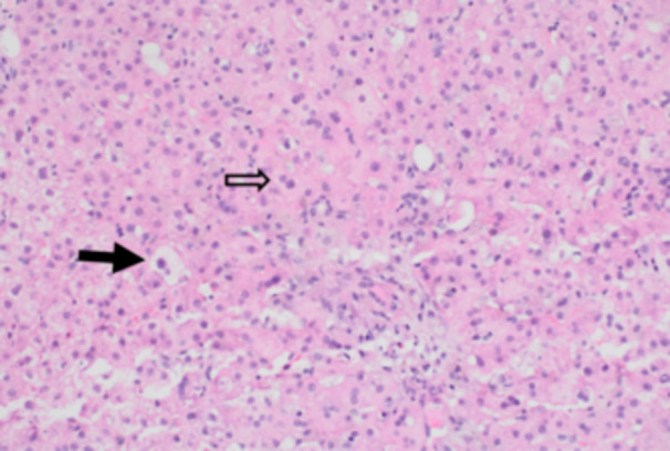 Drug-induced liver injury from Deferasirox in a pediatric patient with hereditary spherocytosis: A case report.