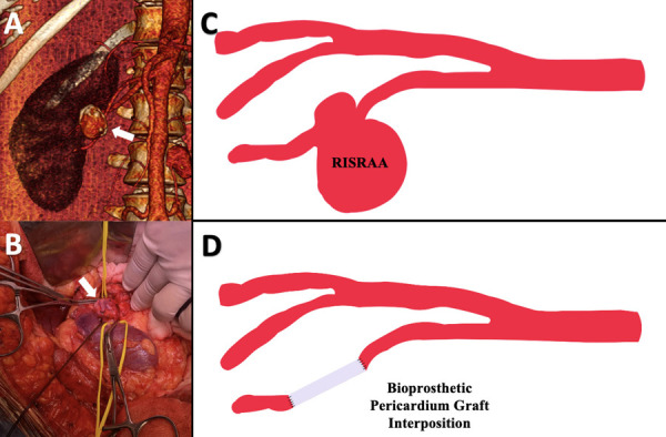 Repair of multiple abdominopelvic aneurysms: is the open approach still valid? A case report.