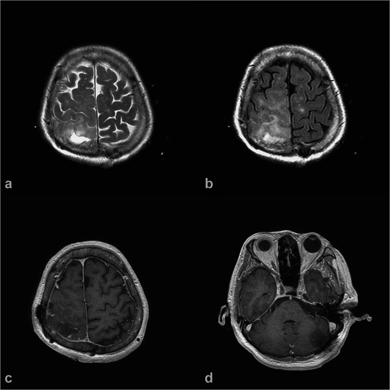 A Rare Case of Dual Primary Supratentorial Glioma and Infratentorial Meningioma.