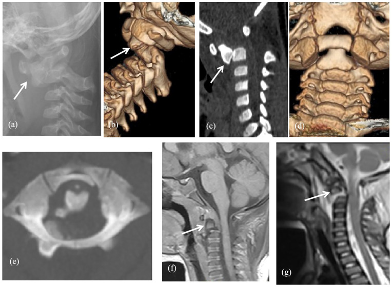Conservative treatment for traumatic atlantoaxial joint infra-anterior dislocation complicating odontoid fracture in young children: A case series.
