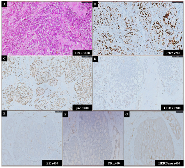 Unveiling Rare Breast Neoplasms: Diagnostic Challenges and Insights.