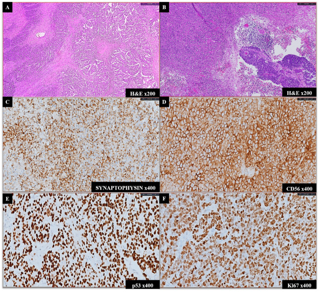 Unveiling Rare Breast Neoplasms: Diagnostic Challenges and Insights.