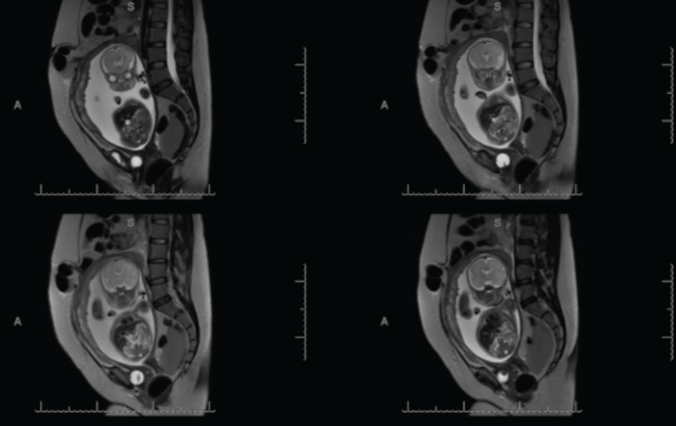 Second-trimester spontaneous uterine rupture: a rare case of diagnostic nuances and multidisciplinary management
