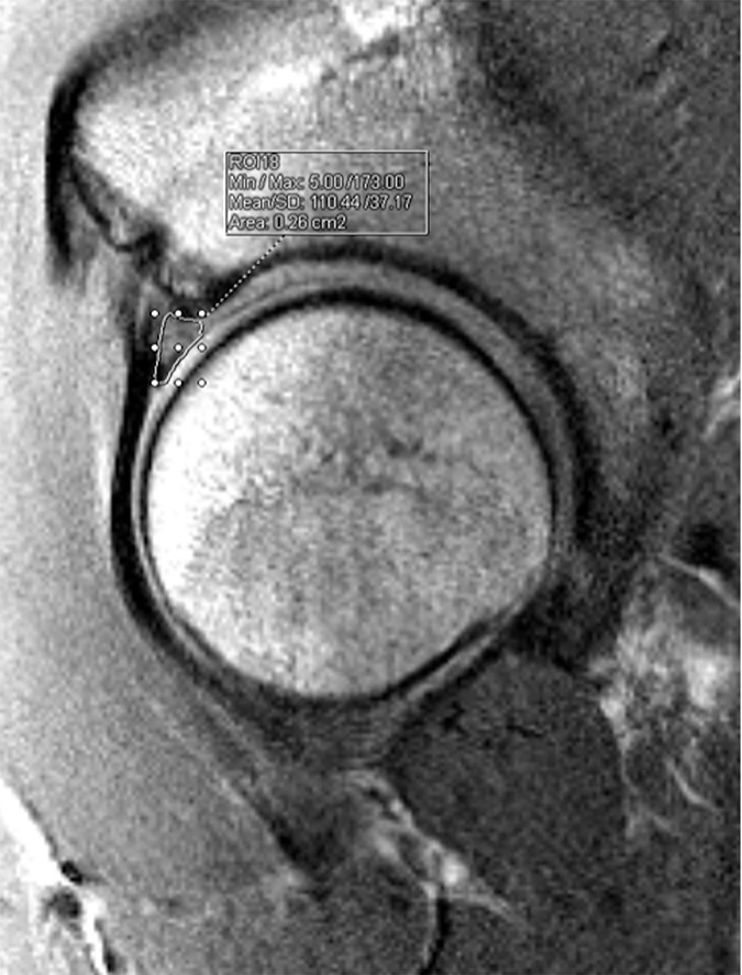 Labral size measured on preoperative magnetic resonance imaging not predictive of the need for labral reconstruction in patients undergoing primary hip arthroscopy.