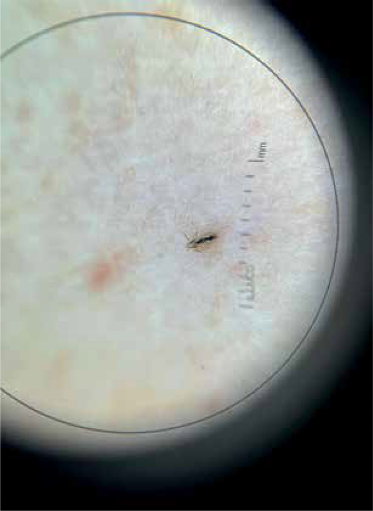 Rare complications of pediculosis capitis.
