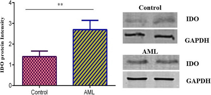 Increased IDO expression and regulatory T cells in acute myeloid leukemia: implications for immune escape and therapeutic targeting.