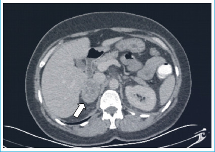 Surgical Management of Acute Appendicitis in a Patient with Diagnosed but "Unprepared" Pheochromocytoma: A Case Report.