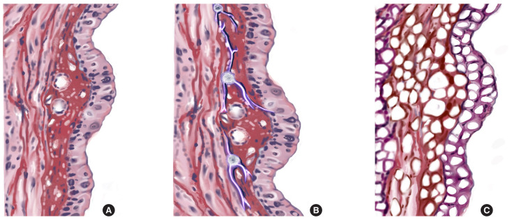A Comparative Study on the Clinical Outcomes of Bipolar Radiofrequency Thermotherapy Versus Transurethral Resection of the Prostate in Storage Symptoms Associated With Benign Prostatic Obstruction.