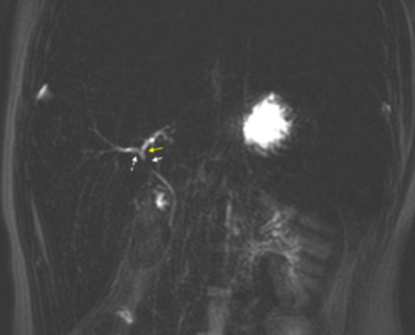 Drug-induced liver injury from Deferasirox in a pediatric patient with hereditary spherocytosis: A case report.