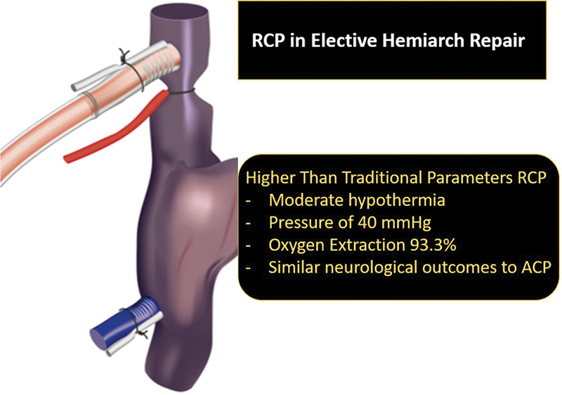 High Flow, High-Pressure Retrograde Cerebral Perfusion at 28°C is Safe and Effective for Hemiarch Replacement of the Ascending Aorta.