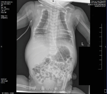 Demineralization of Osseous Structures as Presentation of a Rare Genetic Disorder That Is Associated With a High Rate of Mortality.