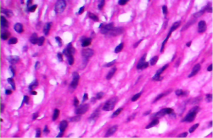 A cellular schwannoma of the nasal septum: a case report.