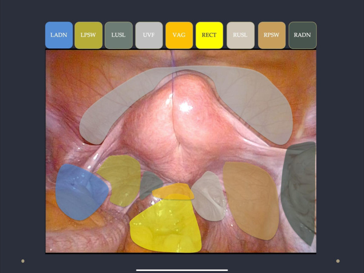 Visual-Numeric Endometriosis Scoring System (VNESS) for mapping surgical findings: A validation study.