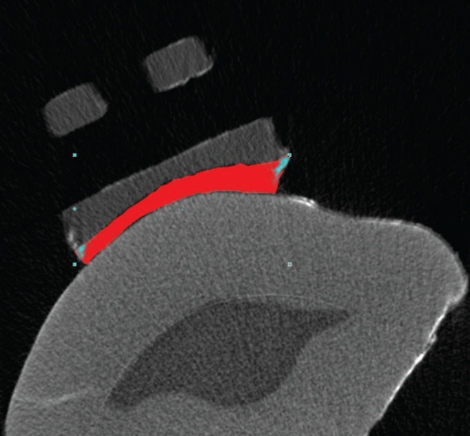 Evaluation of Microleakage in Flash-Free and Conventional Ceramic Brackets: A Microcomputed Tomography Study.