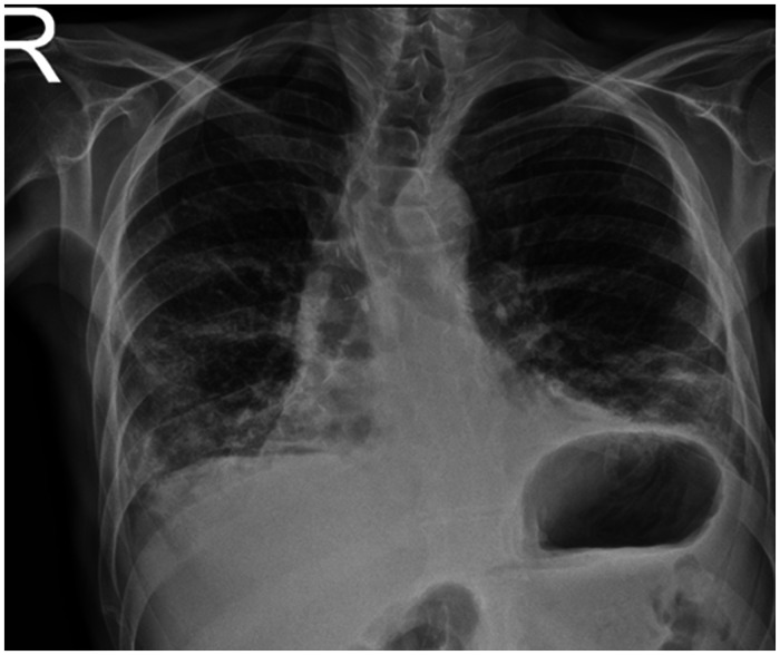 Multiple life-threatening complications in a patient who received lung transplantation due to cystic fibrosis and their management.