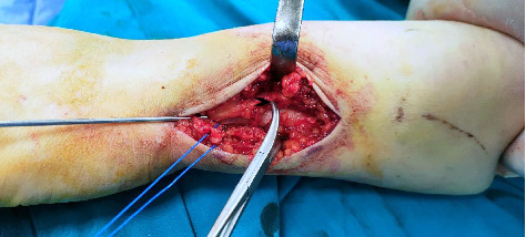 Internal Fixation for Unstable Distal Ulnar Fractures by 2.7 mm Semitubular Hook Plate.