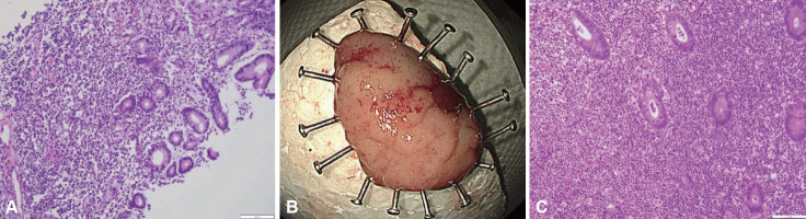 Gastric Subepithelial Lesion Accompanied by Colonic Subepithelial Mass.