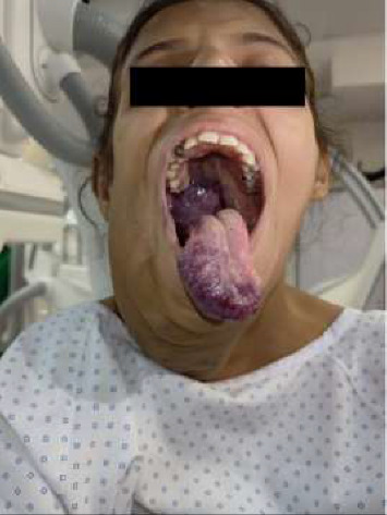 Surviving the Nightmare: Massive Bleeding From Large Intraoral Arteriovenous Malformation During Airway Management for Angioembolization Procedure.