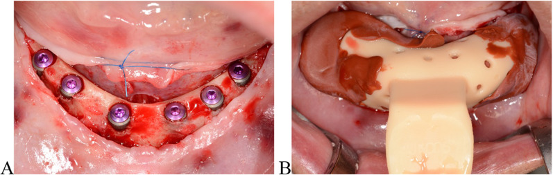 Novel digital technique for assessing circumferential peri-implant bone height.