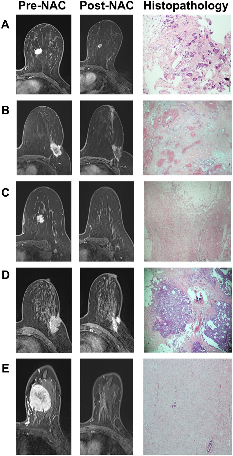 Correlation of Histopathological and Radiological Response Patterns and Their Prognostic Implications in Breast Cancer After Neoadjuvant Chemotherapy.