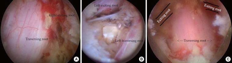 Full-Endoscopic Midline Foraminoplasty: An Alternative Method for Treating Lumbar Foraminal Stenosis.