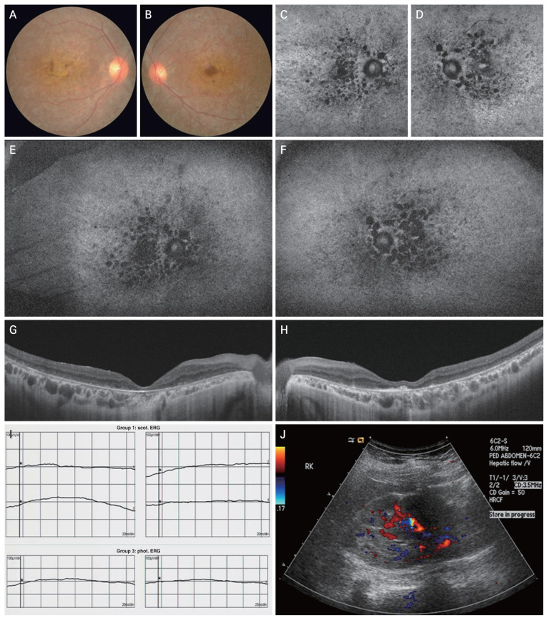 Homozygous Frameshift Mutation in the BBS10 Gene Causing Bardet-Biedl Syndrome with Rod-Cone Dystrophy: A Case Report.