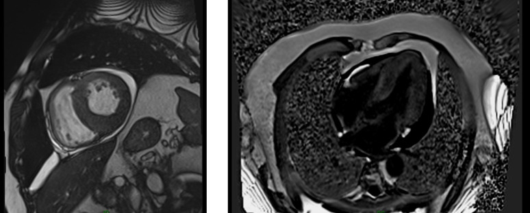 Sustained Ventricular Tachycardia as the first presentation of transthyretin amyloid cardiomyopathy.