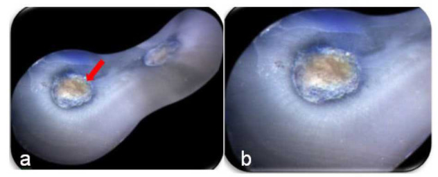 Comparative Evaluation of Crack Propagation During Root Canal Preparation in Primary Molar with Manual Instrumentation, ProTaper Universal and ProTaper Next Rotary File Systems: An <i>in vitro</i> Study.