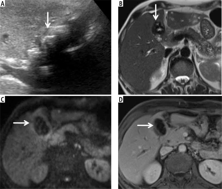 Deep learning-based classification of gallbladder lesions in patients with non-diagnostic (GB-RADS 0) ultrasound.