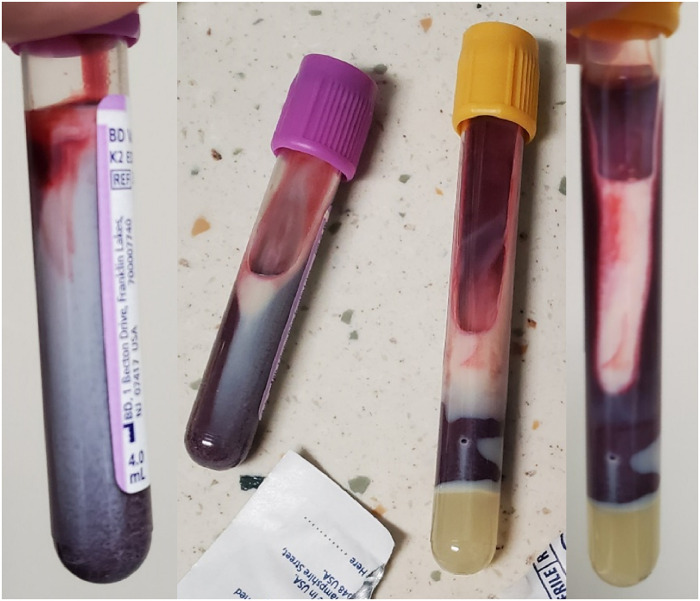 Hyponatremia with an Osmolar Gap, Pseudohyponatremia or Hyper-Osmolar Hyponatremia?