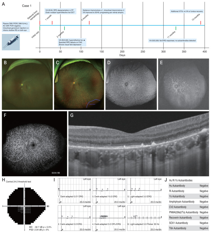 Subacute Toxic Pigmentary Retinopathy after Intravitreal Ganciclovir Injection: A Case Report.