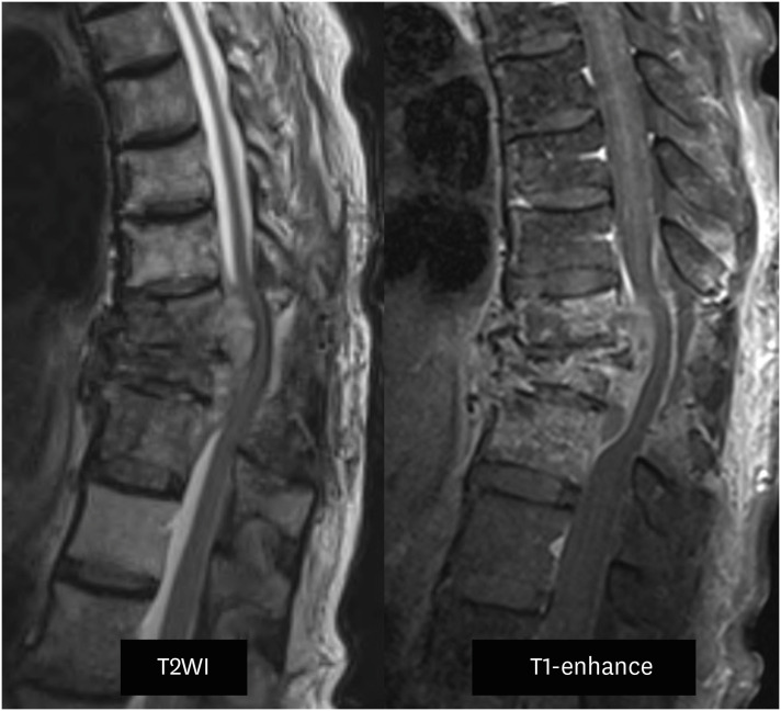 Spinal Cord Injury From Tuberculous Spondylitis Misdiagnosed as Metastatic Spinal Tumor and Bacterial Spondylitis: A Case Report & Literature Review.