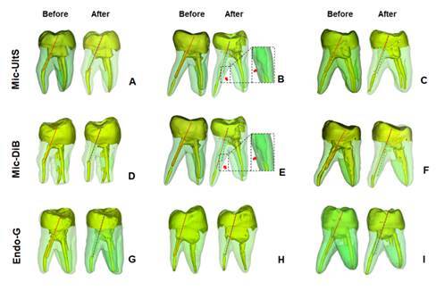 Effect of Fiberglass Post Technique Removal on the Root Dentin Loss, the Root Canal Alignment and the Root Perforation Occurrence.
