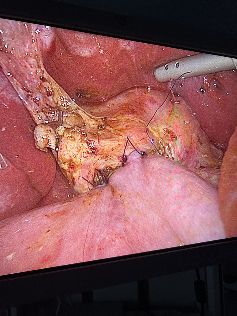 Laparoscopic Hepaticojejunostomy. Initial experience in 21 consecutive cases.
